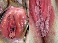 Illustration for article titled Obat Kutil Kelamin Pada Vulva